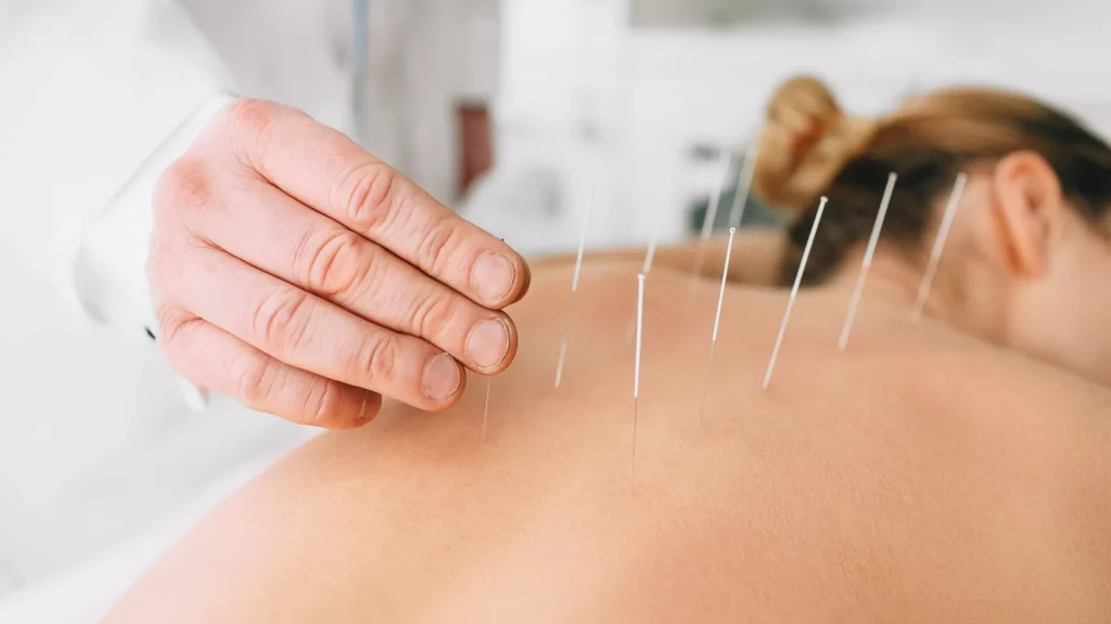 Acupunctura